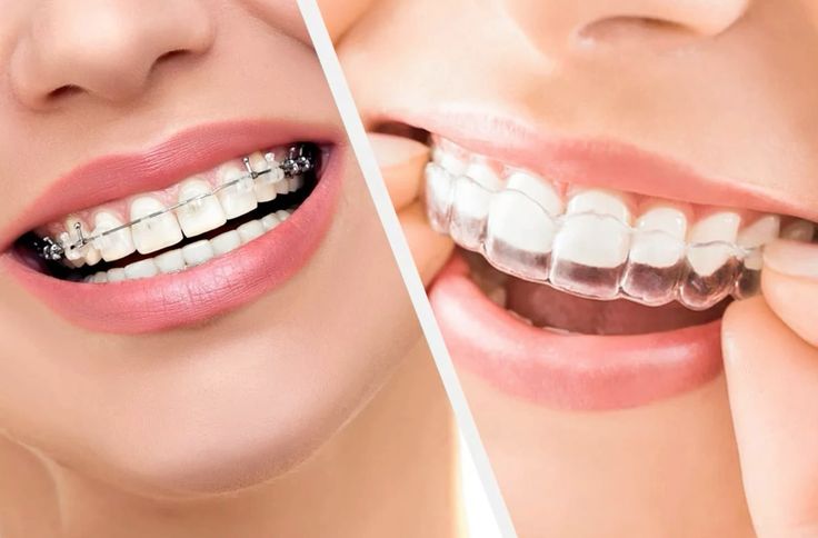 Top 3 Advantages of Using Clear Aligners in Kukatpally