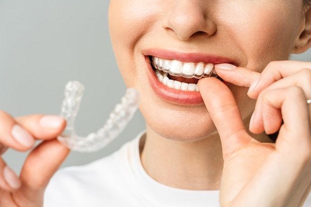 Clear Aligners in Kukatpally