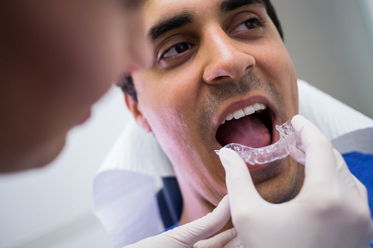 Top 3 Advantages of Using Clear Aligners in Kukatpally