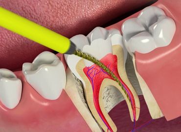 Trusted Root Canal Treatment in Kukatpally