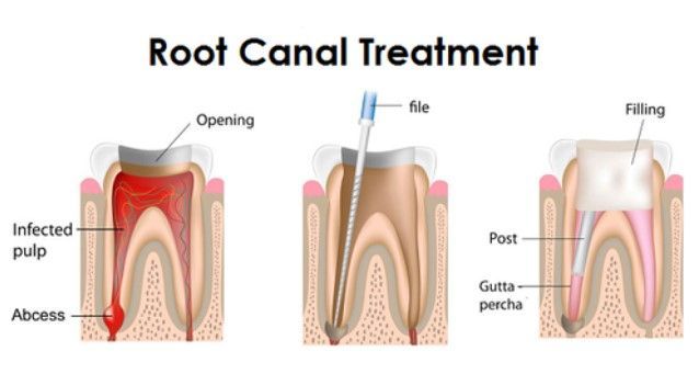 Trusted Root Canal Treatment in Kukatpally