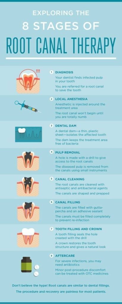 Trusted Root Canal Treatment in Kukatpally
