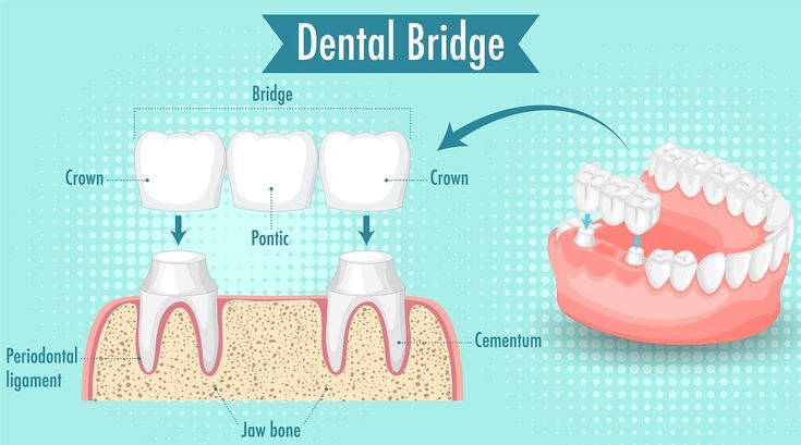 Best Dental Bridges And Crowns Treatment in Kukatpally