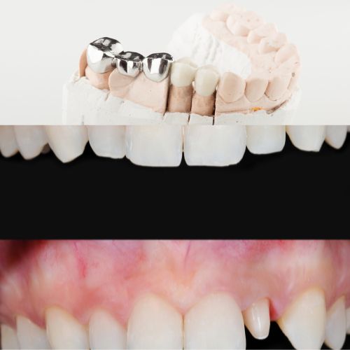 Best Dental Bridges AndCrowns Treatment in Kukatpally