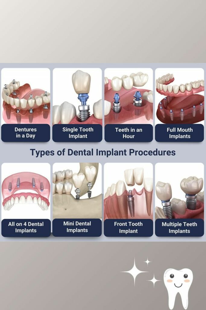 Dental Implants in Kukatpally