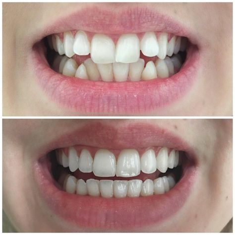 Top 3 Advantages of Using Clear Aligners in Kukatpally