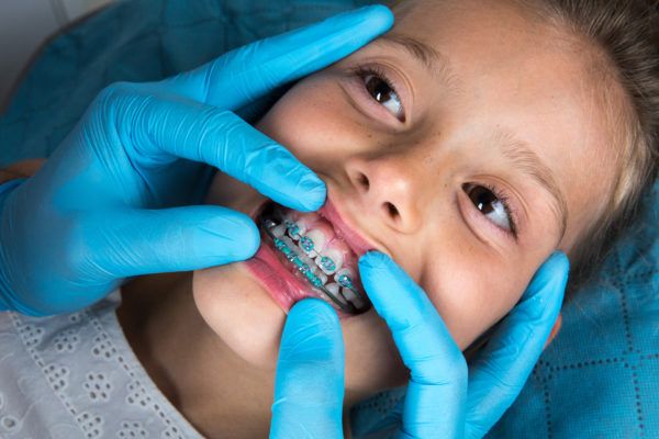 Dental Braces Treatment in Kukatpally