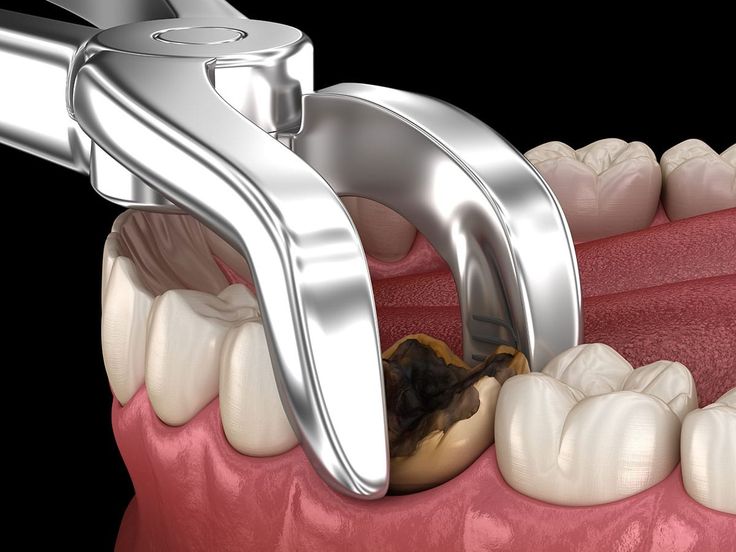 5 Best Safe Wisdom Tooth Removal Services in Kukatpally