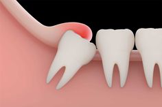 5 Best Safe Wisdom Tooth Removal Services in Kukatpally